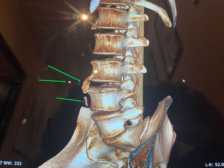 Masaż Yumeiho- TK kręgosłupa 