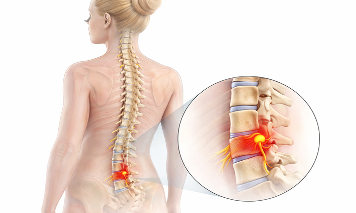 Dyskopatia kręgosłupa – ucisk na nerw, ból pleców i promieniowanie (anatomia).png